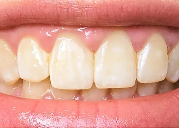 Foto - Daha beyaz görünsün diye sağlığınızdan olmayın! Bu yöntemler dişlerinizi kaybetmenize sebep olabilir