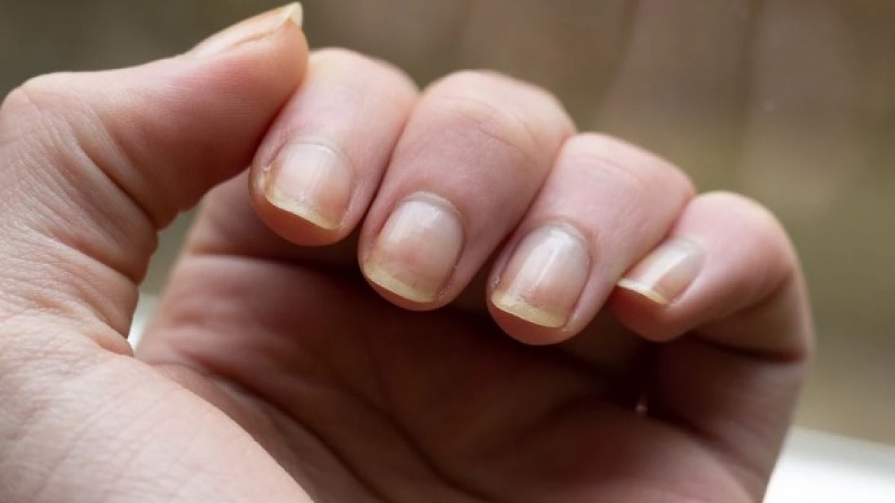 Foto - Dakikalar içinde farkını göreceksiniz! İşte sararmış tırnakları doğal rengine döndürmenin yolu