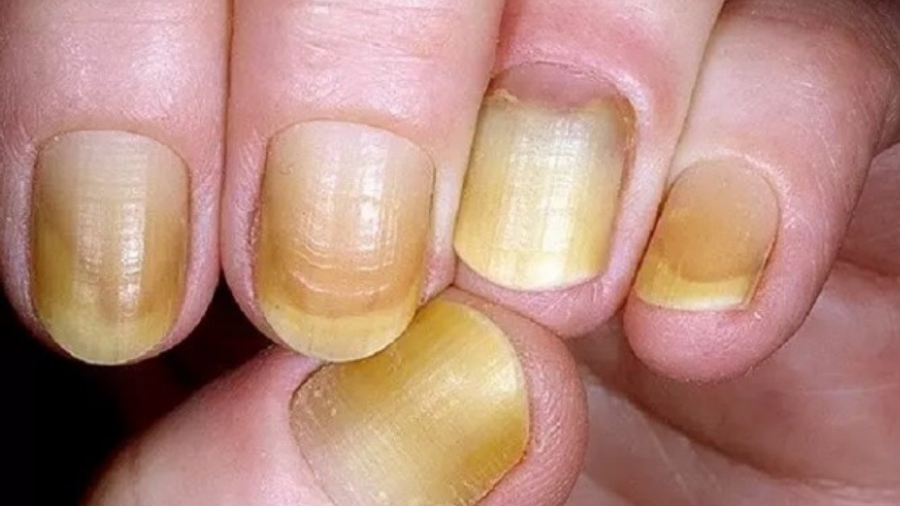 Dakikalar içinde farkını göreceksiniz! İşte sararmış tırnakları doğal rengine döndürmenin yolu