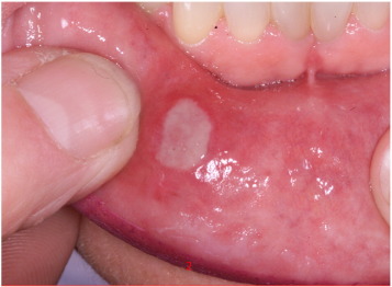 Foto - Damak yaralarına doğal çözüm