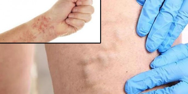 Foto - Damar tıkanıklığına iyi gelen 5 besin! Damarları açan, güçlendiren besinler