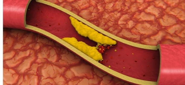 Damar tıkanıklığına iyi gelen besinler