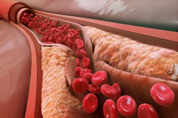 Foto - Damar tıkanıklığına iyi gelen besinler