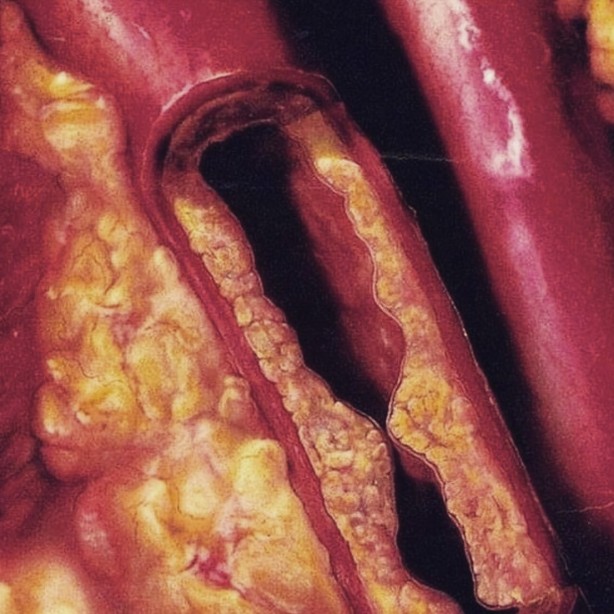 Foto - Damar tıkanıklığına iyi gelen besinler