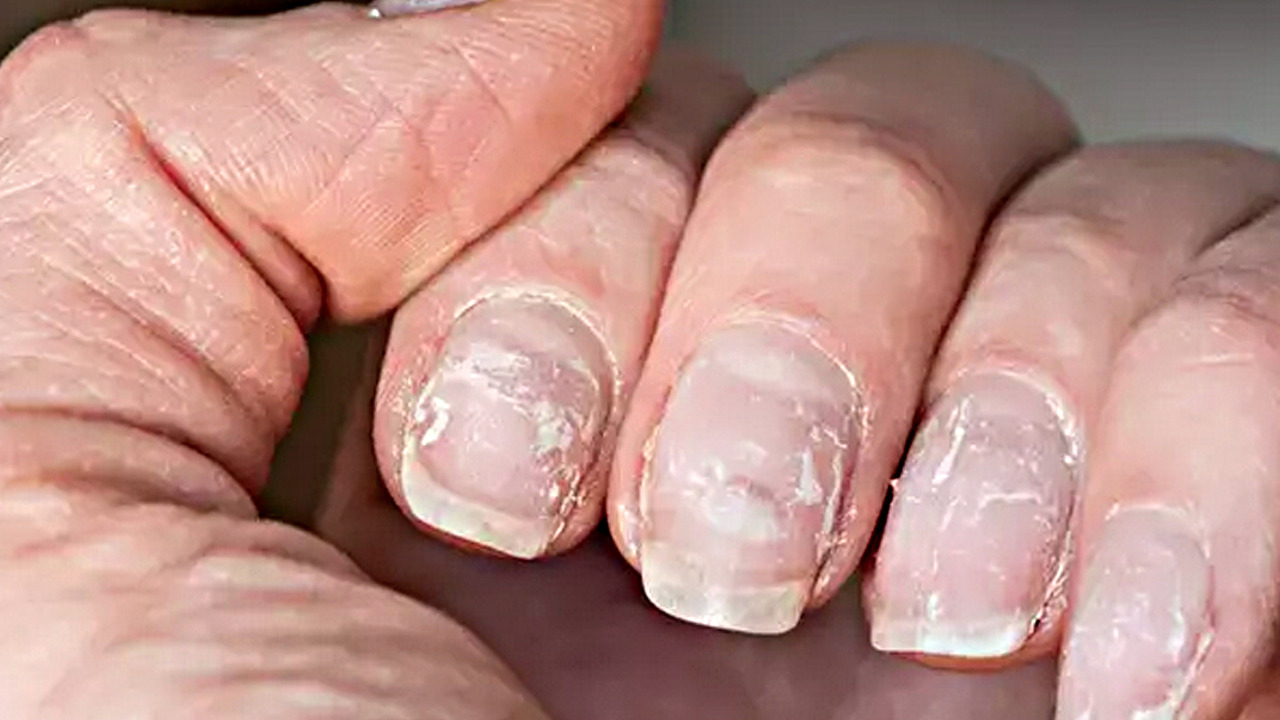 Foto - Demir eksikliğinin 12 önemli belirtisi nelerdir? Demir üretimini hızlandırıyor, cilt sağlığını destekliyor!