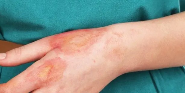 Foto - Demlikte kalan çayı sakın atmayın! Kalan çayla ne yapılır? Demlenmiş çay göze iyi gelir mi?