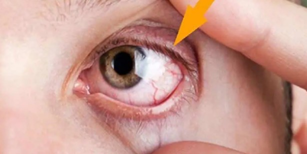 Foto - Demlikte kalan çayı sakın atmayın! Kalan çayla ne yapılır? Demlenmiş çay göze iyi gelir mi?