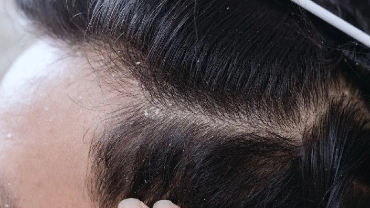 Foto - Deneyince farkını göreceksiniz! Saç kepeğinden kurtulmanın doğal yolu açıklandı