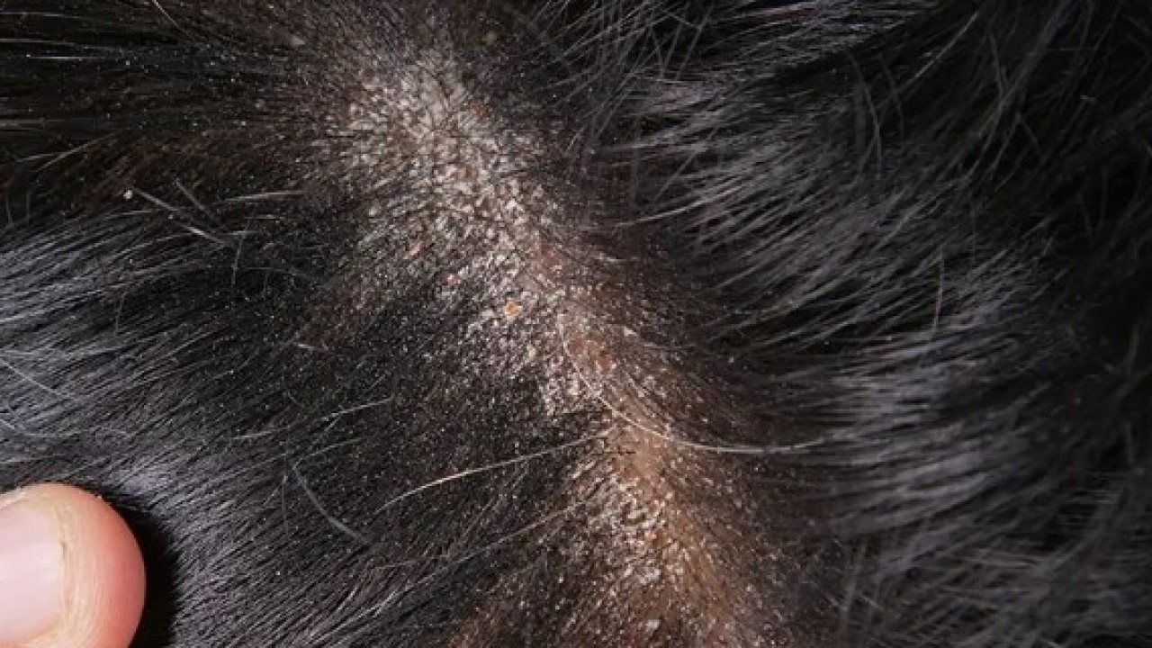 Deneyince farkını göreceksiniz! Saç kepeğinden kurtulmanın doğal yolu açıklandı