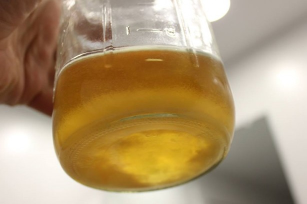 Foto - Dikkat! Bu 12 belirti varsa böbrekleriniz iflas ediyor olabilir