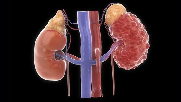 Foto - Dikkat! Bu 12 belirti varsa böbrekleriniz iflas ediyor olabilir