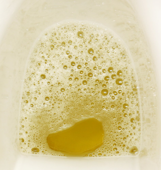 Foto - Dikkat! Bu 12 belirti varsa böbrekleriniz iflas ediyor olabilir