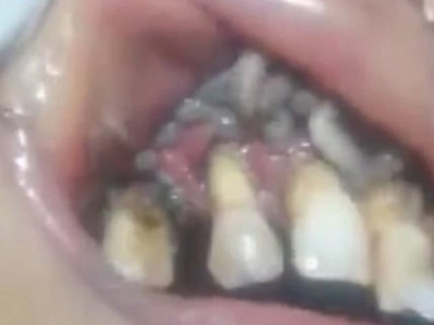 Foto - Dikkat! Bu belirtiler varsa dişinize diş kurdu girmiş olabilir