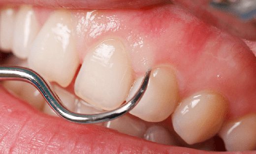 Foto - Dikkat! Bu belirtiler varsa dişinize diş kurdu girmiş olabilir