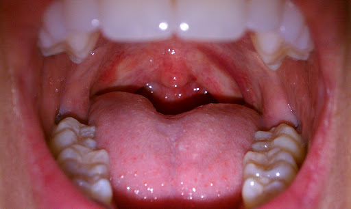 Foto - Dikkat! Bu belirtiler varsa dişinize diş kurdu girmiş olabilir