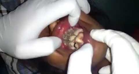 Foto - Dikkat! Bu belirtiler varsa dişinize diş kurdu girmiş olabilir