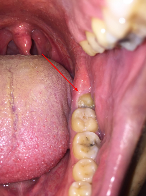 Foto - Dikkat! Bu belirtiler varsa dişinize diş kurdu girmiş olabilir