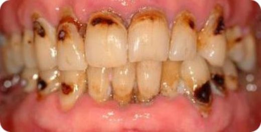 Foto - Dikkat! Bu belirtiler varsa dişinize diş kurdu girmiş olabilir