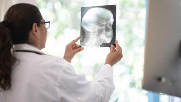 Foto - Dikkat! Bu beslenme tarzı, Alzheimer'ı hızlandırıyor