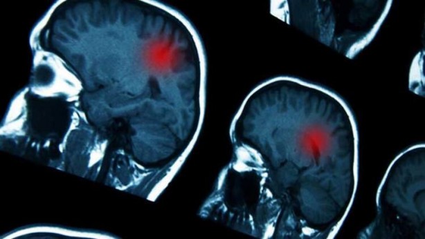 Foto - Dikkat! Bu beslenme tarzı, Alzheimer'ı hızlandırıyor