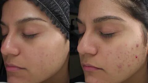 Foto - Dikkat! Sivilceler bakın neyin belirtisi…