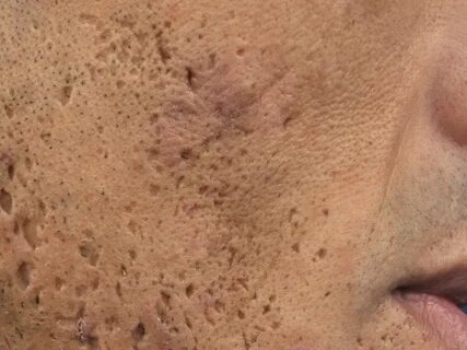 Foto - Dikkat! Sivilceler bakın neyin belirtisi…