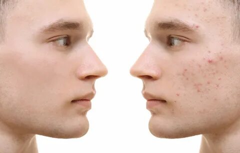 Foto - Dikkat! Sivilceler bakın neyin belirtisi…