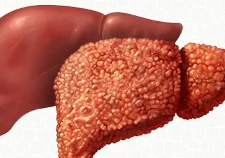 Foto - Dikkat! Sivilceler bakın neyin belirtisi…