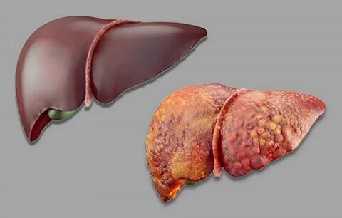Foto - Dikkat! Sivilceler bakın neyin belirtisi…