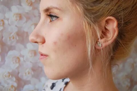 Foto - Dikkat! Sivilceler bakın neyin belirtisi…