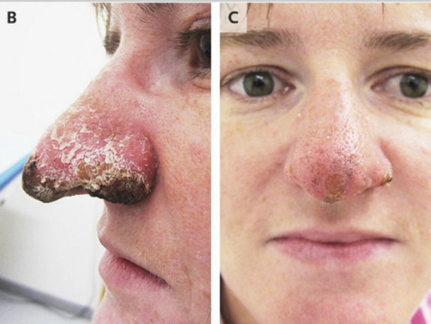 Foto - Dikkat size de olabilir! Burnu çürüdü!