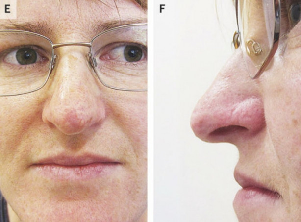 Foto - Dikkat size de olabilir! Burnu çürüdü!