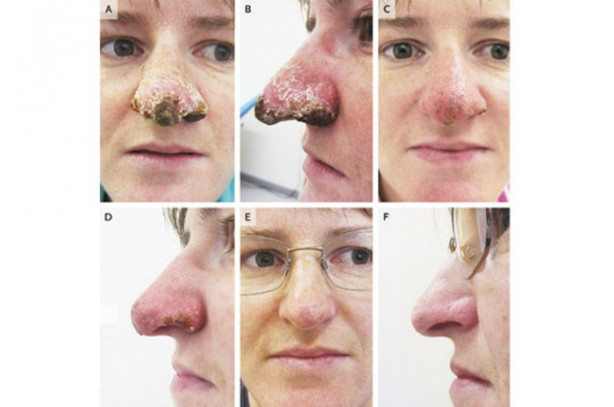 Dikkat size de olabilir! Burnu çürüdü!