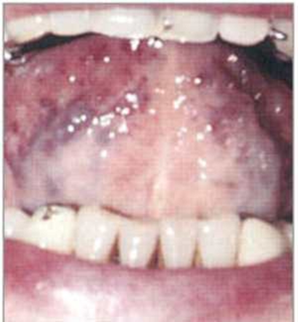 Foto - Dilinize bakarak hastalığınızı öğrenin!