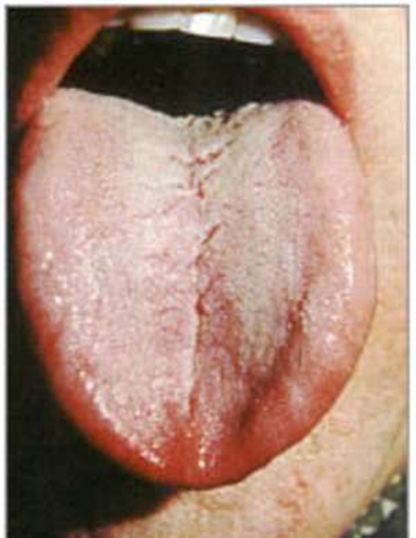 Foto - Dilinize bakarak hastalığınızı öğrenin!