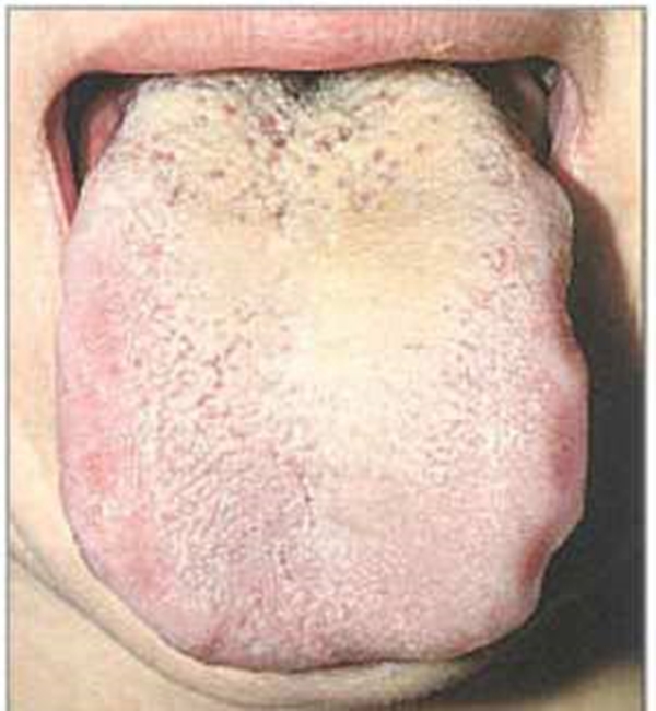 Foto - Dilinize bakarak hastalığınızı öğrenin!