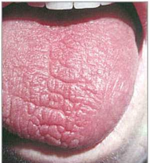 Foto - Dilinize bakarak hastalığınızı öğrenin!