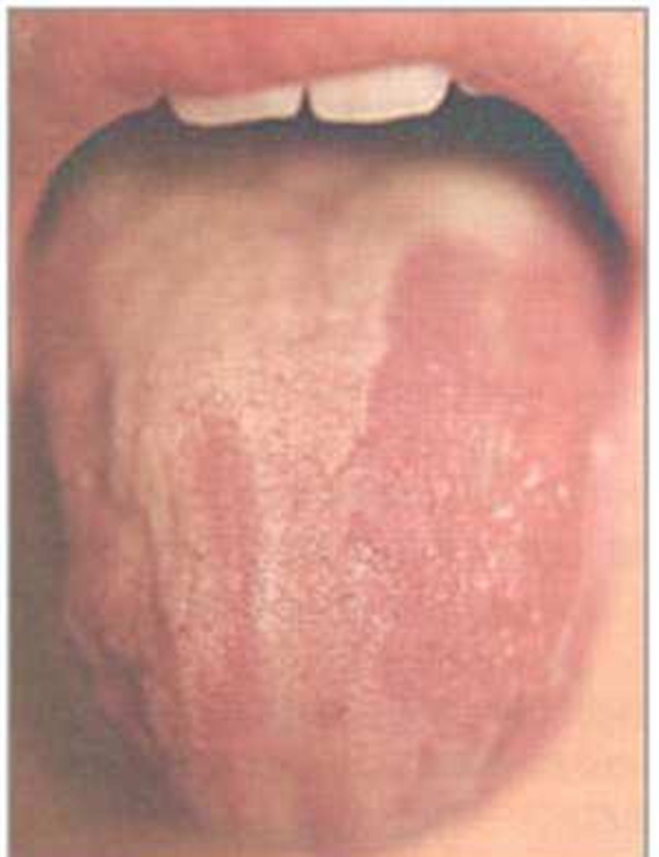 Foto - Dilinize bakarak hastalığınızı öğrenin!