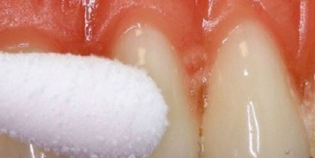 Diş ağrısını anında kesiyor: Çılgın tedavide zencefil, sarımsak, nane yaprakları hamlesi! Çok şaşıracaksınız 