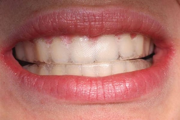 Foto - Diş beyazlatanlar dikkat! Karartıyor...