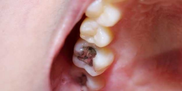 Foto - Diş çürüklerini durduran 10 bitki