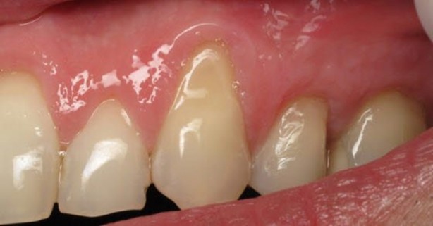 Foto - Diş eti büyümesi hastalık habercisi