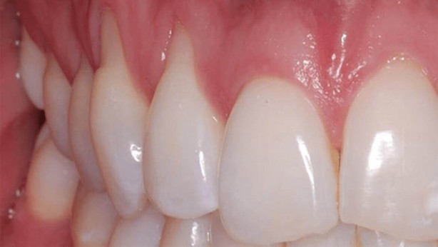 Foto - Diş eti sorunlarını ihmal etmeyin! Daha ciddi problemlerin habercisi olabilir