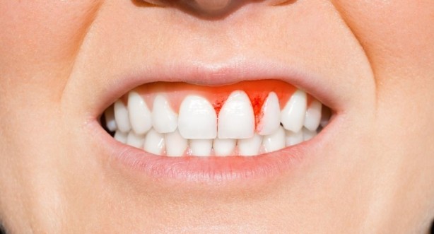 Foto - Diş eti sorunlarını ihmal etmeyin! Daha ciddi problemlerin habercisi olabilir