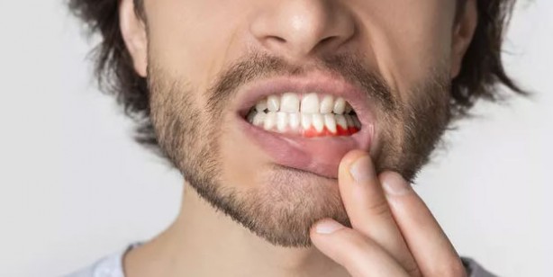 Foto - Diş eti sorunlarını ihmal etmeyin! Daha ciddi problemlerin habercisi olabilir