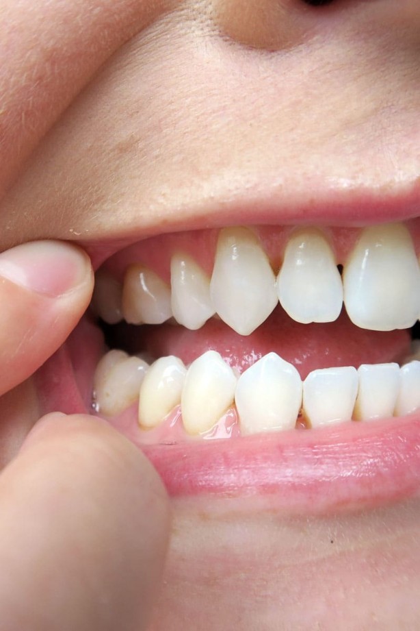 Foto - Diş eti sorunlarını ihmal etmeyin! Daha ciddi problemlerin habercisi olabilir