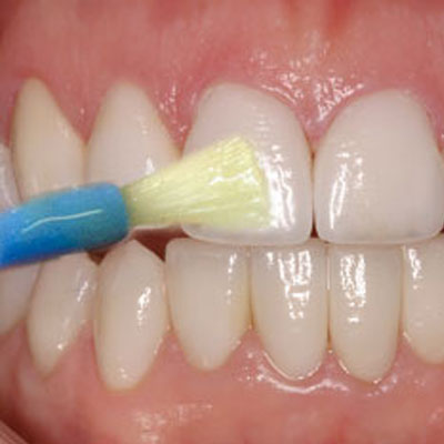 Foto - Diş eti sorunlarını ihmal etmeyin! Daha ciddi problemlerin habercisi olabilir