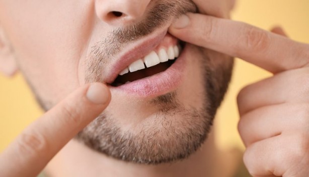 Diş eti sorunlarını ihmal etmeyin! Daha ciddi problemlerin habercisi olabilir