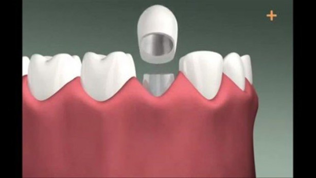 Foto - Diş implantı nasıl yapılıyor?