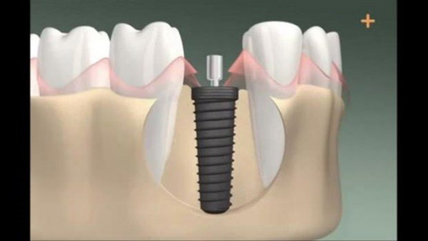 Foto - Diş implantı nasıl yapılıyor?